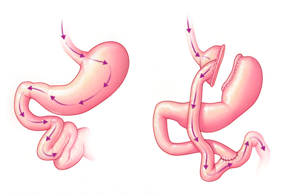 Cirugía Bariátrica